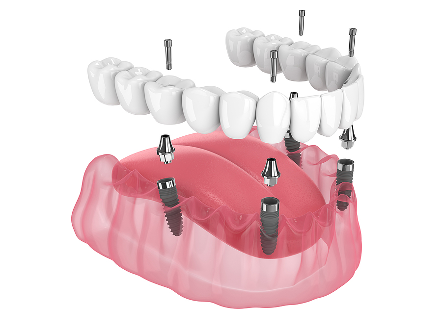 All-on-4 Dental Implants: A Revolutionary Solution for Full-Arch Tooth Replacement