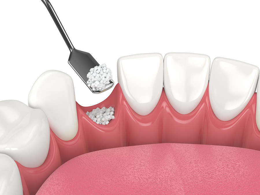 Restoring Jawbone Health: Bone Grafting in Santa Maria and Arroyo Grande, CA