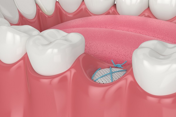 Socket Preservation Graft After Tooth Extraction