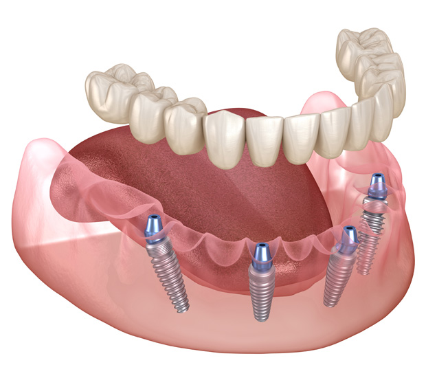 Santa Maria All-on-4 Dental Implants