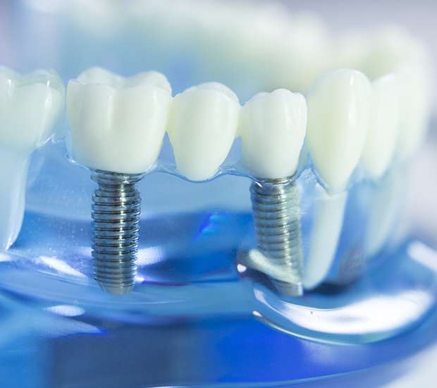 Santa Maria Dental Implants