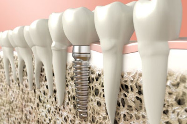 An Oral Surgeon Discusses Dental Implant Surgery