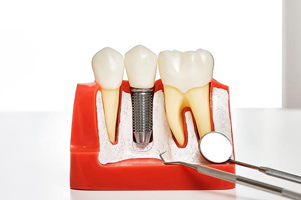 Your Guide to Different Kinds of Dental Implants from Wilson Oral Surgery in Santa Maria, CA